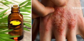 ეს უნივერსალური ზეთი ნამდვილი დამხმარეა – ფსორიაზი და ჰერპესი ამის წყალობით დავამარცხე!