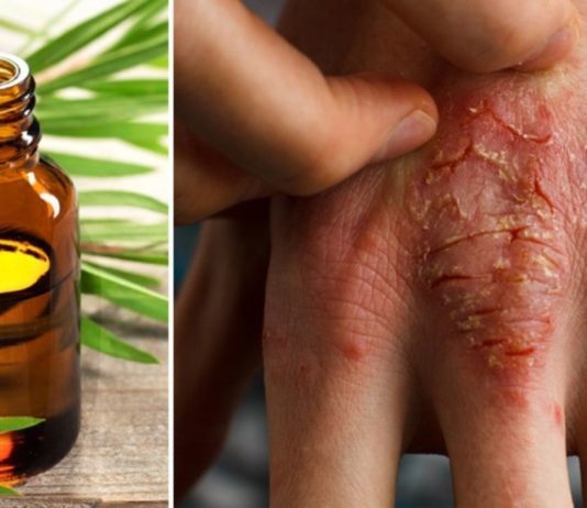 ეს უნივერსალური ზეთი ნამდვილი დამხმარეა – ფსორიაზი და ჰერპესი ამის წყალობით დავამარცხე!