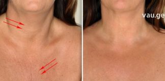 6 საუკეთესო გზა ყელისა და დეკოლტეს მიდამოში ნაოჭების მოსაშორებლად!