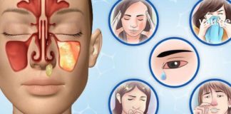 ჰაიმორიტის მკურნალობის 7 ყველაზე სწრაფი მეთოდი სახლიდან გაუსვლელად!