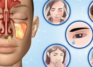 ჰაიმორიტის მკურნალობის 7 ყველაზე სწრაფი მეთოდი სახლიდან გაუსვლელად!