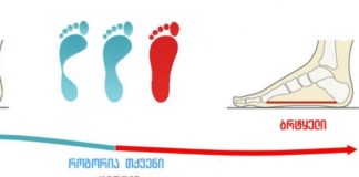 მნიშვნელოვანი ინფორმაცია: რა შეიძლება გამოიწვიოს ბრტყელტერფიანობამ?!