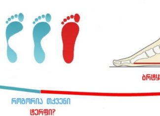 მნიშვნელოვანი ინფორმაცია: რა შეიძლება გამოიწვიოს ბრტყელტერფიანობამ?!