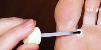 აქამდე უცნობი ყველაზე ეფექტური და უმტკივნეულო მეთოდები მაზოლების მოსაცილებლად!