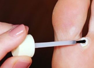 აქამდე უცნობი ყველაზე ეფექტური და უმტკივნეულო მეთოდები მაზოლების მოსაცილებლად!