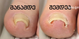 მოირჩინეთ ჩაზრდილი ფჩხილი მხოლოდ ერთ კვირაში ამ ხელნაკეთი საშუალებებით სახლიდან გაუსვლელად!