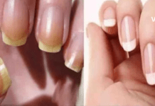 გაყვითლებული ფრჩხილების სამკურნალოდ შეგიძლიათ გამოიყენოთ იაფი და მარტივი სახლის მეთოდები, რომელთა განხილვაც მოხდება ამ სტატიაში.