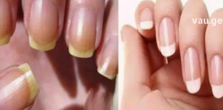 გაყვითლებული ფრჩხილების სამკურნალოდ შეგიძლიათ გამოიყენოთ იაფი და მარტივი სახლის მეთოდები, რომელთა განხილვაც მოხდება ამ სტატიაში.