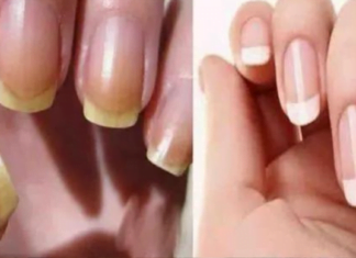 გაყვითლებული ფრჩხილების სამკურნალოდ შეგიძლიათ გამოიყენოთ იაფი და მარტივი სახლის მეთოდები, რომელთა განხილვაც მოხდება ამ სტატიაში.