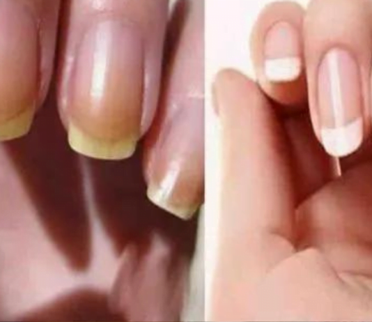 გაყვითლებული ფრჩხილების სამკურნალოდ შეგიძლიათ გამოიყენოთ იაფი და მარტივი სახლის მეთოდები, რომელთა განხილვაც მოხდება ამ სტატიაში.