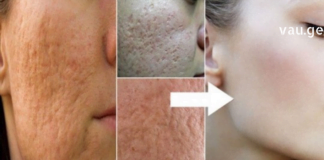 კომერციული პროდუქტებისა და მკურნალობის გამოყენების ნაცვლად, შეეცადეთ გამოიყენოთ ბუნებრივი საშუალებები გადიდებული ფორებისთვის. გთავაზობთ, სცადოთ ეს სამ ეტაპიანი მეთოდი ზედიზედ 3 დღის განმავლობაში.