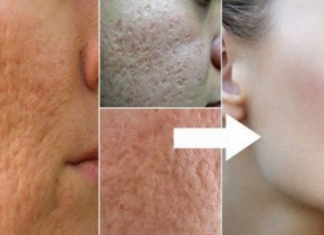 კომერციული პროდუქტებისა და მკურნალობის გამოყენების ნაცვლად, შეეცადეთ გამოიყენოთ ბუნებრივი საშუალებები გადიდებული ფორებისთვის. გთავაზობთ, სცადოთ ეს სამ ეტაპიანი მეთოდი ზედიზედ 3 დღის განმავლობაში.