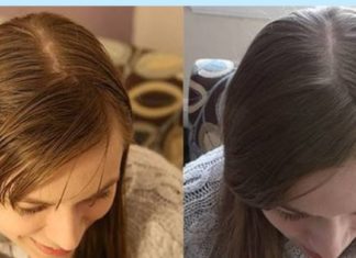 ცხიმიანმა თმამ მთელი ახალგაზრდობა გამიმწარა – ბევრი წვალების შემდეგ მივაგენი კიდეც რამდენიმე მართლაც ეფექტურ საშუალებას.