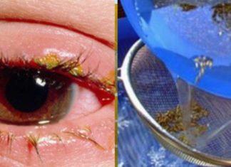 სასწრაფოდ! ვისაც თვალების სიწითლე და გაღიზიანება აწუხებს გირჩევთ გაეცნოთ ამ რეცეპტებს!