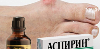 იოდი საუკეთესო დამხმარე აღმოჩნდა პოდაგრას სამკურნალოდ – საკუთარ თავზე გამოვცადე და კმაყოფილი ვარ..