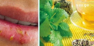ამ მარტივი რჩევების ცოდნით, თქვენ არ ინერვიულებთ გარეგნული იერის გამო, როცა ჰერპესის ინფექცია მწვავდება: ამ სტატიაში შეიტყობთ, როგორ უმკურნალოდ ჰერპესს სახლის პირობებში.
