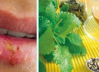 ამ მარტივი რჩევების ცოდნით, თქვენ არ ინერვიულებთ გარეგნული იერის გამო, როცა ჰერპესის ინფექცია მწვავდება: ამ სტატიაში შეიტყობთ, როგორ უმკურნალოდ ჰერპესს სახლის პირობებში.