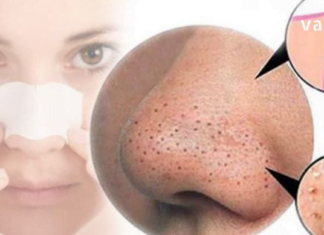 შავი წერტილები კანზე ალბათ ყველაზე გავრცელებული პრობლემაა დღევანდელ დროში, განსაკუთრებით, ცხვირის, ნიკაპის და შუბლის მიდამოში. გაგიზიარებთ ჩემს მეთოდს, თუ როგორ ვიყენებ ჩაის ხის ზეთს!