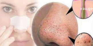 ამ მეთოდით შეძლებთ სამუდამოდ გაიქროთ შავი წერტილები -ჩემი მეგობრები გაოცდნენ შედეგით