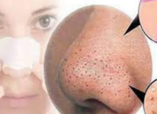 ამ მეთოდით შეძლებთ სამუდამოდ გაიქროთ შავი წერტილები -ჩემი მეგობრები გაოცდნენ შედეგით