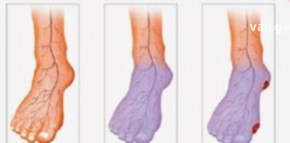 სისხლის ცუდი მიმოქცევა: 4 ნიშანი, რომელიც საფრთხეს უქმნის ჯანმრთელობას -ამის შესახებ ყველამ უნდა იცოდეს!