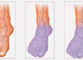 სისხლის ცუდი მიმოქცევა: 4 ნიშანი, რომელიც საფრთხეს უქმნის ჯანმრთელობას -ამის შესახებ ყველამ უნდა იცოდეს!