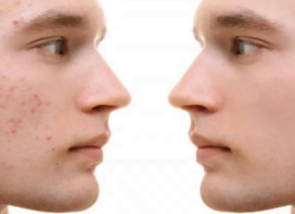 Მე, ისევე როგორც ბევრს, მუწუკების პრობლემა მაქვს. ცოტა ხნის წინ ძალიან მარტივი, მაგრამ ეფექტური რეცეპტი აღმოვაჩინე, რაც ძალიან დამეხმარა.