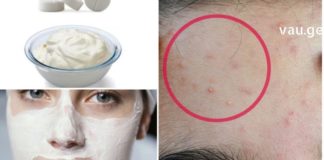 მე ვზრუნავ სახის კანზე: მარტივად ვასუფთავებ კანს აკნესგან და ვავიწროვებ ფორებს !