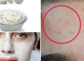 მე ვზრუნავ სახის კანზე: მარტივად ვასუფთავებ კანს აკნესგან და ვავიწროვებ ფორებს !