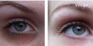 როგორ მოვიშოროთ მუქი წრეები თვალების ქვეშ: 5 ბუნებრივი მეთოდი