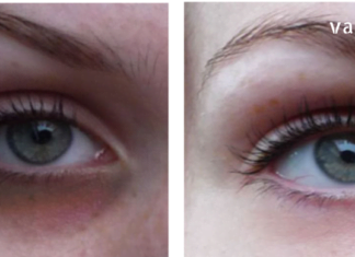 როგორ მოვიშოროთ მუქი წრეები თვალების ქვეშ: 5 ბუნებრივი მეთოდი