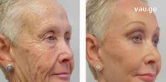 გთავაზობთ გაეცნოთ ნაოჭების საწინააღმდეგო ყველაზე ეფექტურ მეთოდებს. მათი რეგულარული გამოყენების შემდეგ, თქვენ რამდენიმე წლით უფრო ახალგაზრდულად გამოიყურებით…