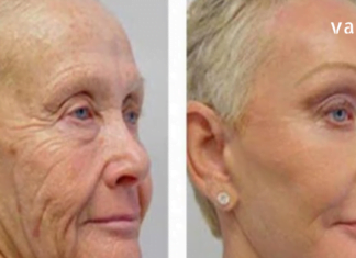 გთავაზობთ გაეცნოთ ნაოჭების საწინააღმდეგო ყველაზე ეფექტურ მეთოდებს. მათი რეგულარული გამოყენების შემდეგ, თქვენ რამდენიმე წლით უფრო ახალგაზრდულად გამოიყურებით…