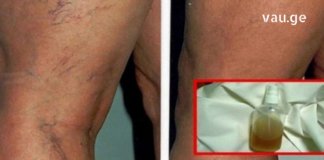 მოშორეთ კაპილარების პრობლემა, დაუბრუნეთ კანს სილამაზე საოცარი ბალზამით-ეფექტური საშუალებაა!