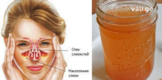 აი რას აკეთებს ვაშლის ძმარი სინუსური ინფექციების წინააღმდეგ! საჭირო ინფორმაციააა…