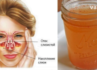 აი რას აკეთებს ვაშლის ძმარი სინუსური ინფექციების წინააღმდეგ! საჭირო ინფორმაციააა…