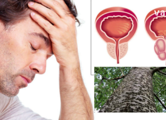 ჩემ მეუღლეს წლების წინ პროსტატის ადენომა დაუდგინდა. ბევრი მკურნალობის შემდეგ, ხალხურ რეცეპტებს მიაგნობდა თავიც გადაირჩნა.