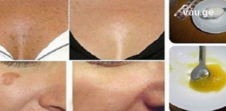 ამ “ფაფებით’ დაიბანეთ სახის კანი და შესაძლოა შემდგომ საკუთარ თვალებსაც კი აღარ დაუჯეროთ!! ჭორფლების გაქრობაზე ოცნება ასეთი ხელმისაწვდომი ჯერ არ ყოფილა !