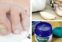 ხალხური მეთოდები ფრჩხილის სოკოს სამკურნალოდ. შედეგი გარანტირებულია!