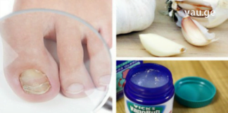 ხალხური მეთოდები ფრჩხილის სოკოს სამკურნალოდ. შედეგი გარანტირებულია!