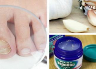 ხალხური მეთოდები ფრჩხილის სოკოს სამკურნალოდ. შედეგი გარანტირებულია!