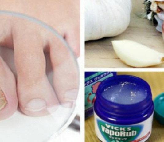 ხალხური მეთოდები ფრჩხილის სოკოს სამკურნალოდ. შედეგი გარანტირებულია!