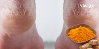 ხალხური მეთოდი დამსკდარი ქუსლების სამკურნალოდ: კურკუმას, სპირტის და ასპირინის გამოყენებით.