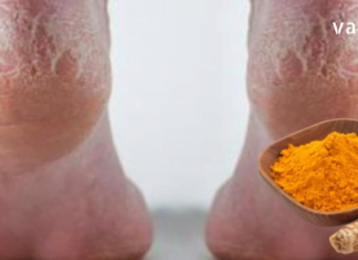 ხალხური მეთოდი დამსკდარი ქუსლების სამკურნალოდ: კურკუმას, სპირტის და ასპირინის გამოყენებით.