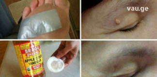 თუ ამას გააკეთებთ, 1 სუფრის კოვზიც კი საკმარისი იქნება, რომ ამოფხვრას პაპილომა უმოკლეს დროში!!