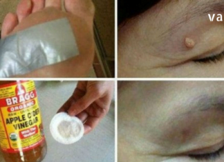 თუ ამას გააკეთებთ, 1 სუფრის კოვზიც კი საკმარისი იქნება, რომ ამოფხვრას პაპილომა უმოკლეს დროში!!