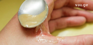 დედამ ეს გასაოცარი მალამო წამისვა როდესაც ხელი ცხელი წყლით დავისწვი. შედეგი მართლაც განმაცვიფრებელი აღმოჩნდა.