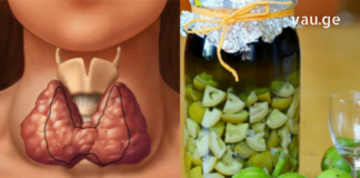 გახდი საკუთარი თავის ექიმი! ჩიყვის მკურნალობის 7 მარტივი გზა სახლის პირობებში!