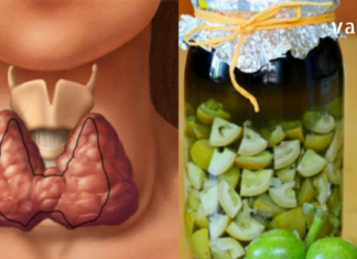 გახდი საკუთარი თავის ექიმი! ჩიყვის მკურნალობის 7 მარტივი გზა სახლის პირობებში!