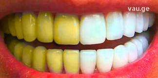 თუ ამას გააკეთებთ ერთი ცდაც საკმარისი იქნება, რომ გქონდეთ ქათქათა კბილები!